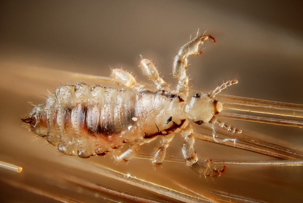 5 things parents need to know about so-called 'mutant head lice'