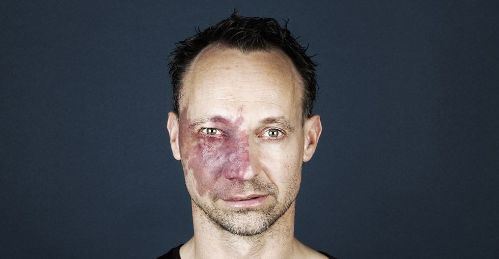 A powerful portrait series shows us the beauty of birthmarks.