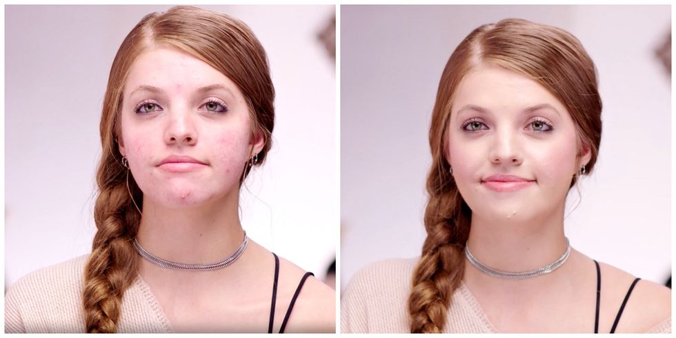 Her struggle with her acne is a lesson in developing a healthy relationship with makeup.