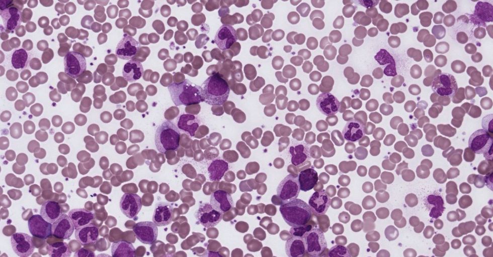 HIV-Positive for 30 Years, San Francisco Man’s Blood May Hold Cure