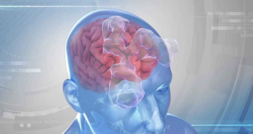 Scientists Make History by Breaking Blood-Brain Barrier to Treat Woman’s Tumor