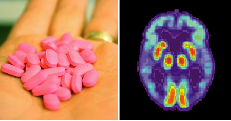 Studies Link Long-Term Use Of Allergy Medicine To Mental Illness