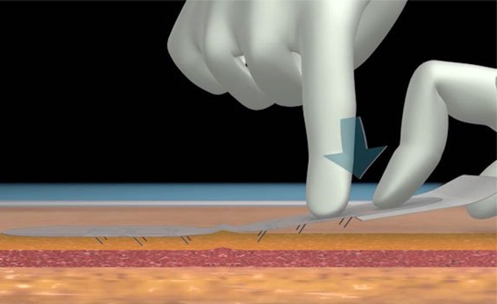 This Brilliant ‘Skin Closure Device’ Could Replace Sutures And Staples For Millions Of Medical Patients