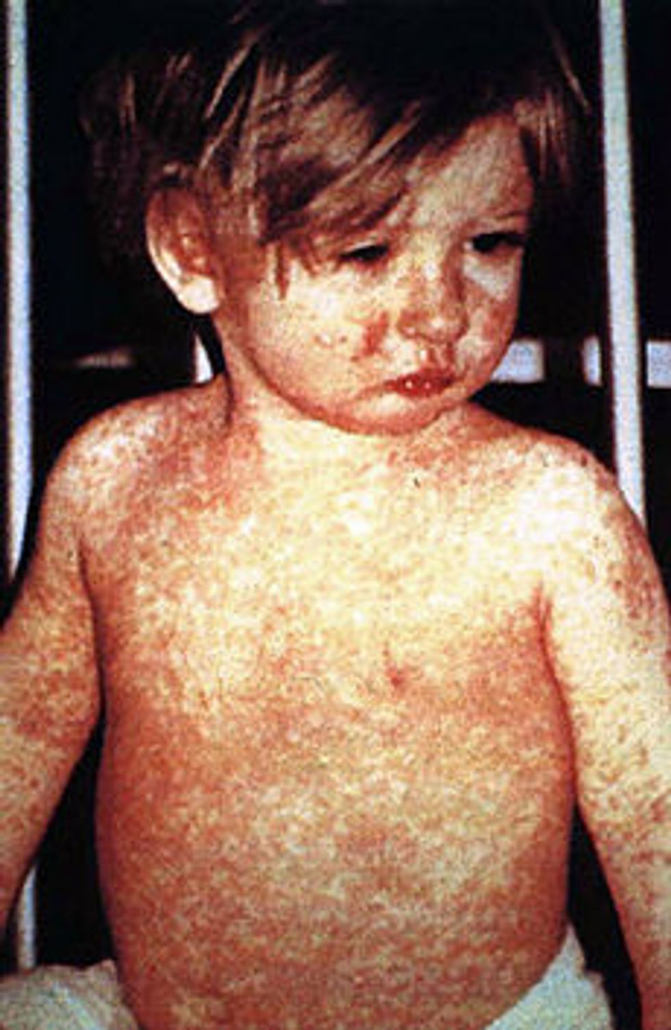 U.S. Lawmakers Are Souring on Anti-Vaxxers’ Personal Belief Exemptions