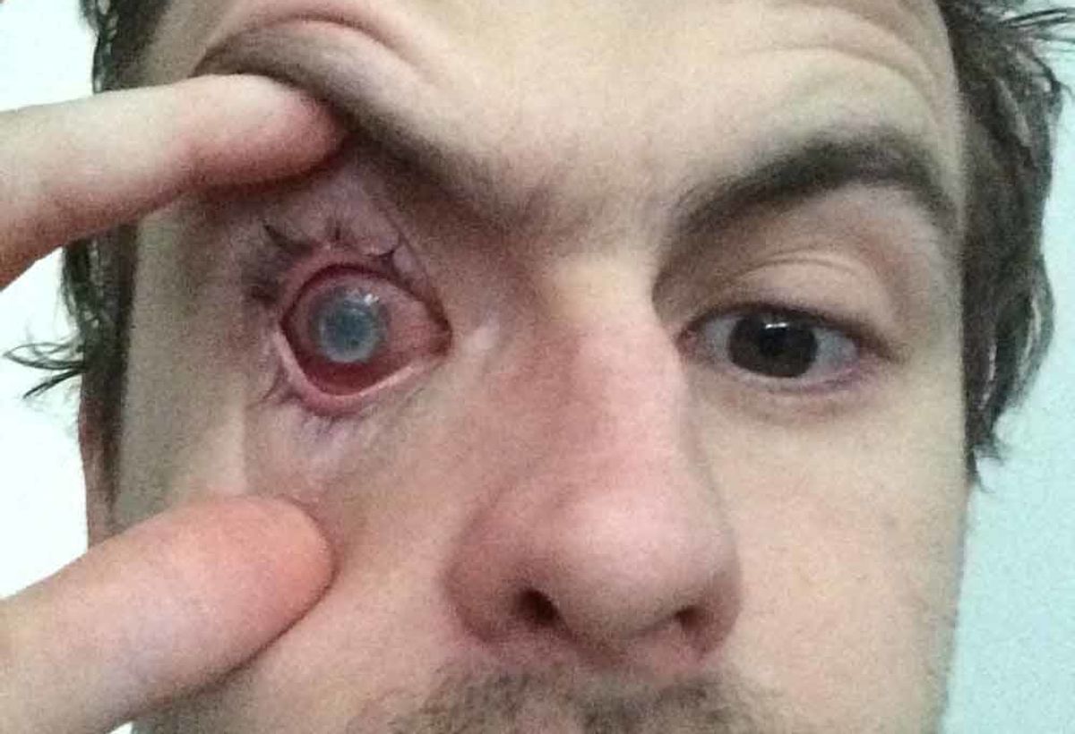 Man Has A Warning For Others After Wearing A Contact Lens In The Shower Leaves Him Blind