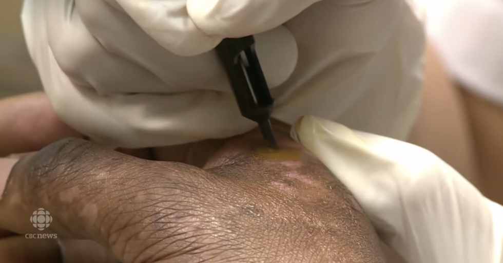 These Invisible Tattoos Cover Up Burn Scars