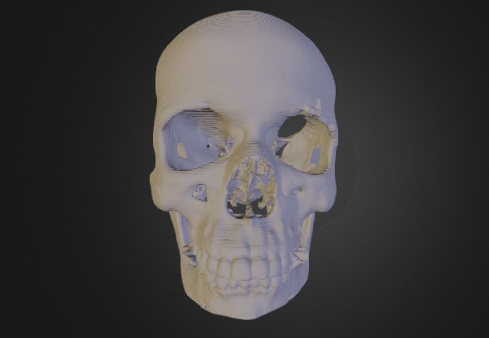 This Woman Can See Because Her Husband 3D-Printed Her Tumor