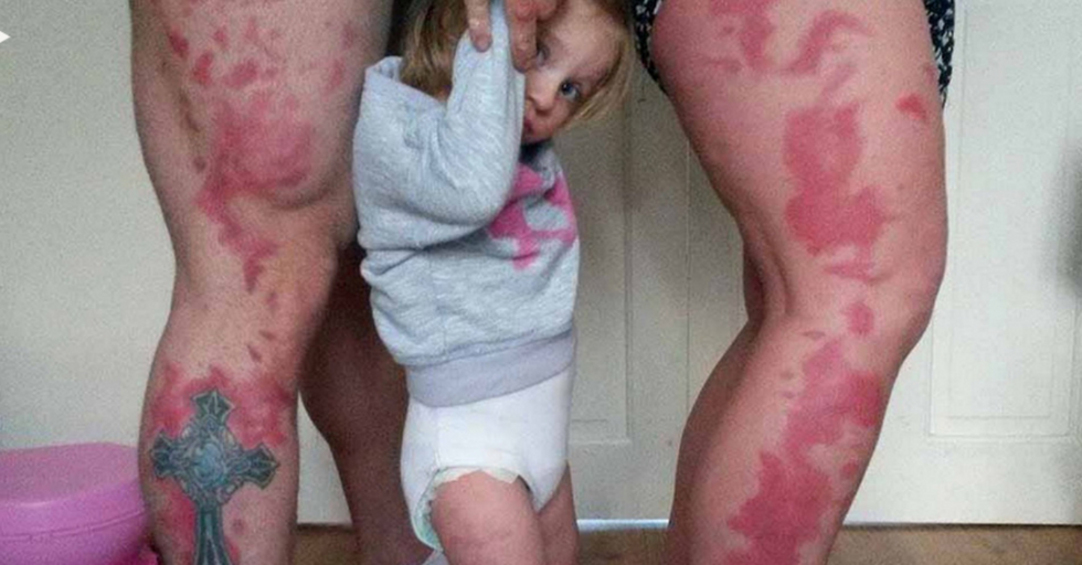 Parents Get Tattoos to Match Their Daughter’s Giant Birthmark, So She Can Feel Normal