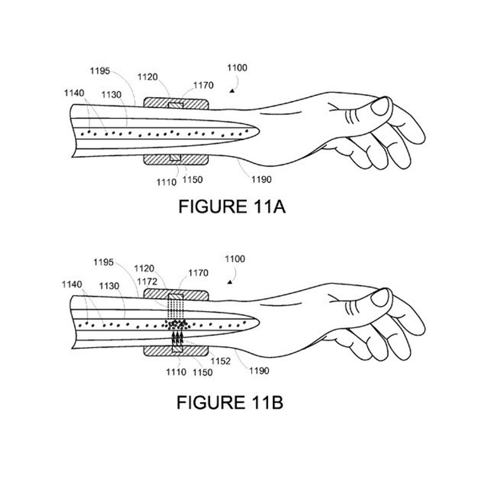 Is a Cancer-Zapping Watch On Its Way?