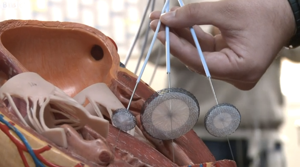 The Bolivian Women Knitting Heart Plugs for Kids With Heart Defects