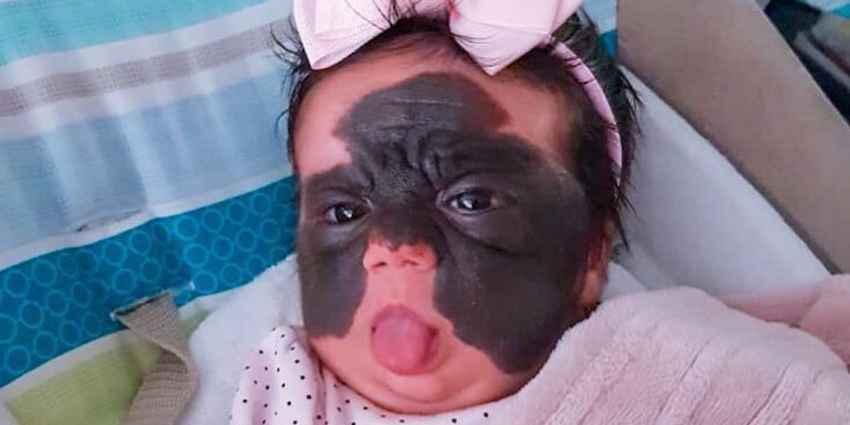 Mother Of Girl With 'Batman' Birthmark Covering Her Face Has A Message For Strangers Who Call Her Baby A 'Monster'