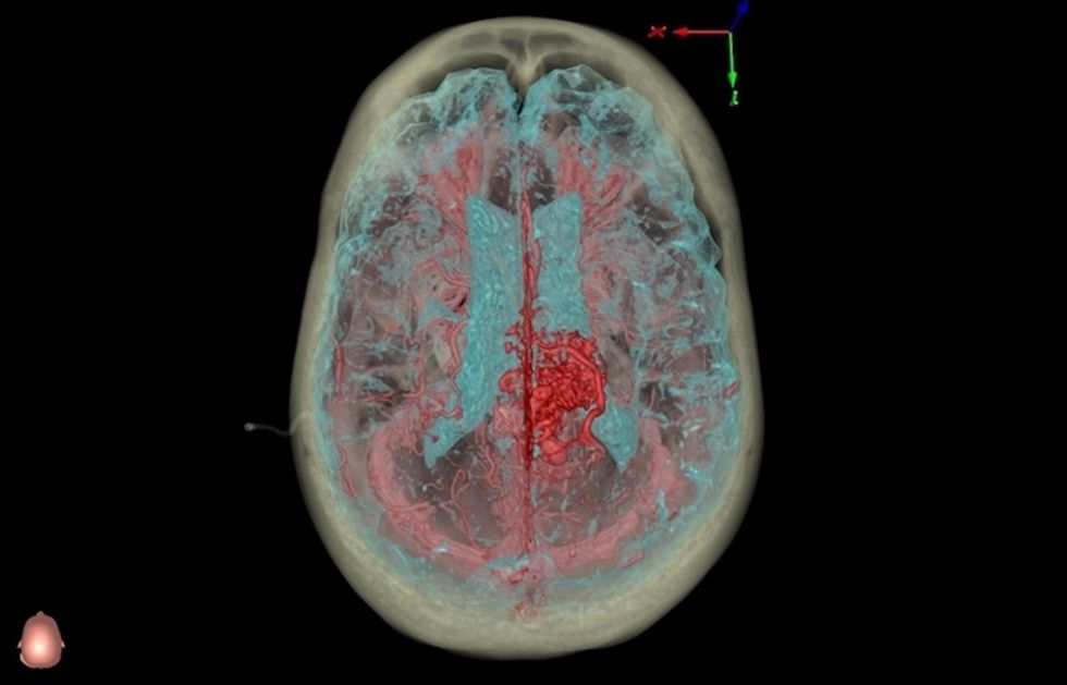 A scan of a brain with red and blue highlights scattered across the screen