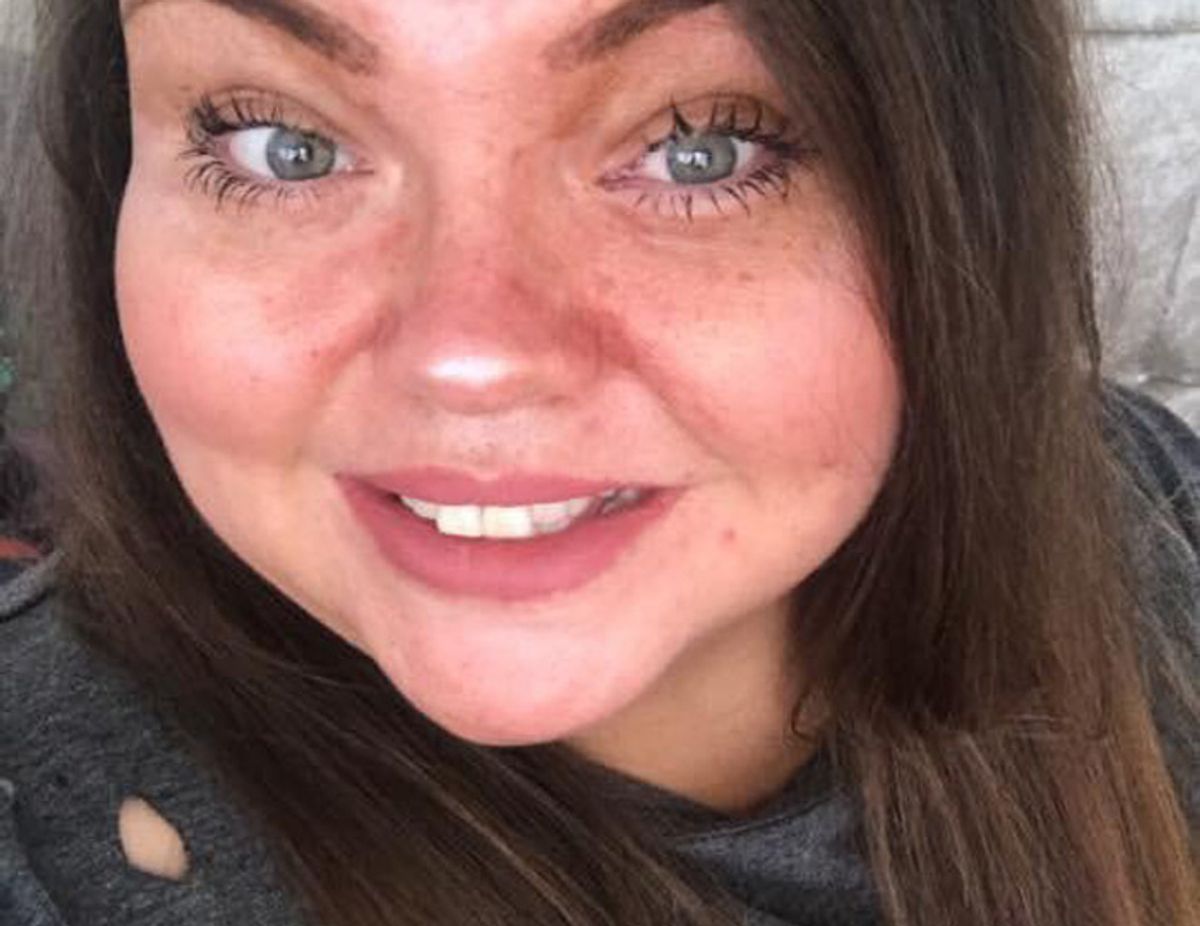 Psoriasis Sufferer Opens Up About How 95 Percent Of Her Body Is Covered By Painful Leopard-Like Spots