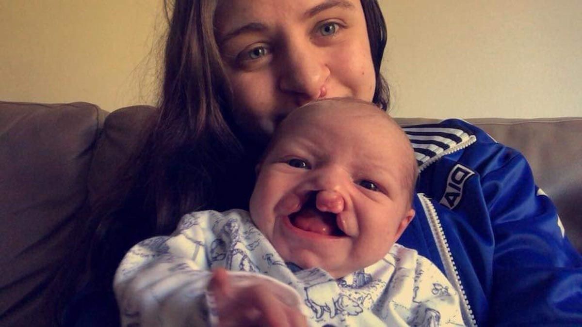 Mom Devastated By Strangers' Cruel Comments About Her Son Who Was Born With A Cleft Palate