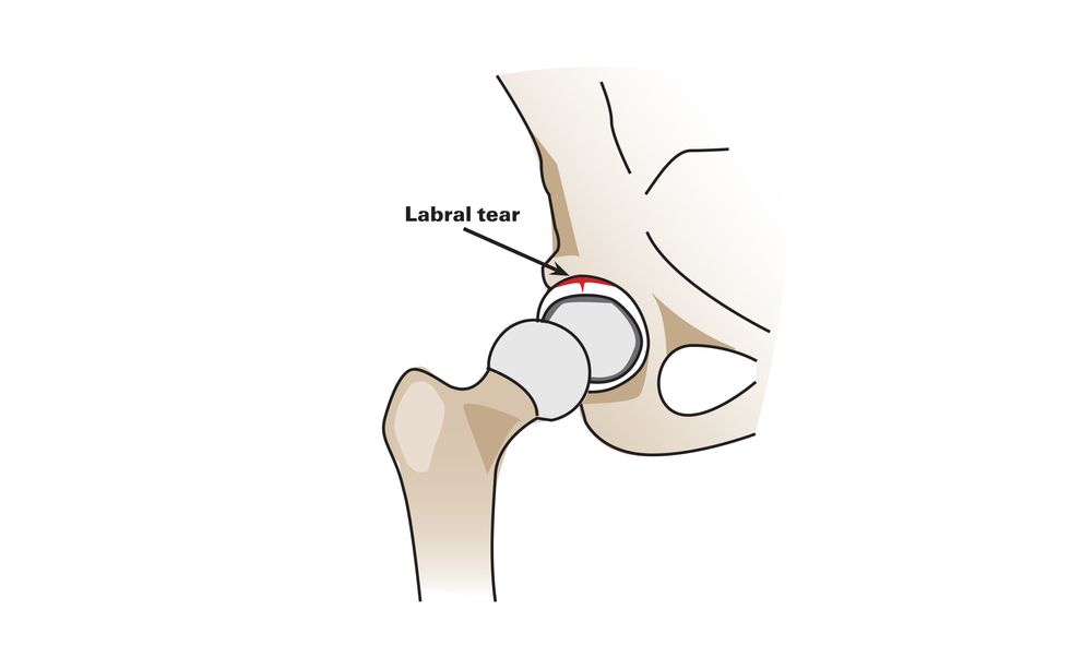 Illustration of a pelvis and hip pone showing the location of a labral tear.
