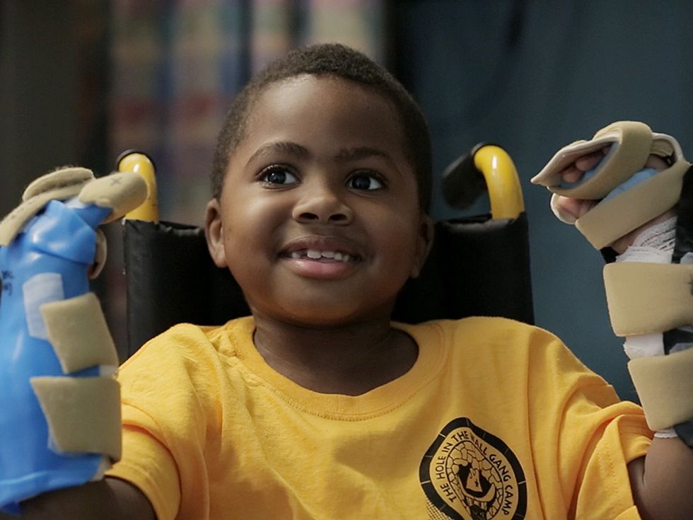 World's First Pediatric Double Hand Transplant A Success