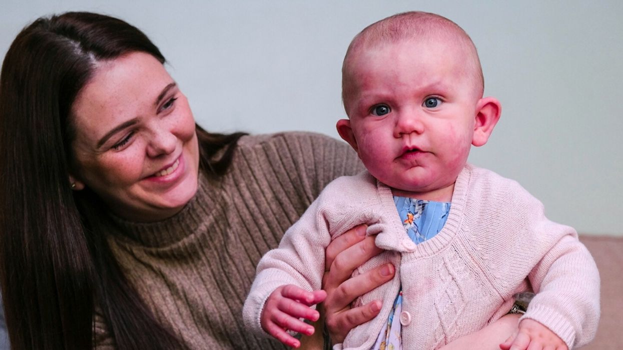 Mom Of Girl With 'Purple' Birthmarks Admits She Hid Her For Six Weeks After Her Birth For Fear Of What Strangers Might Say
