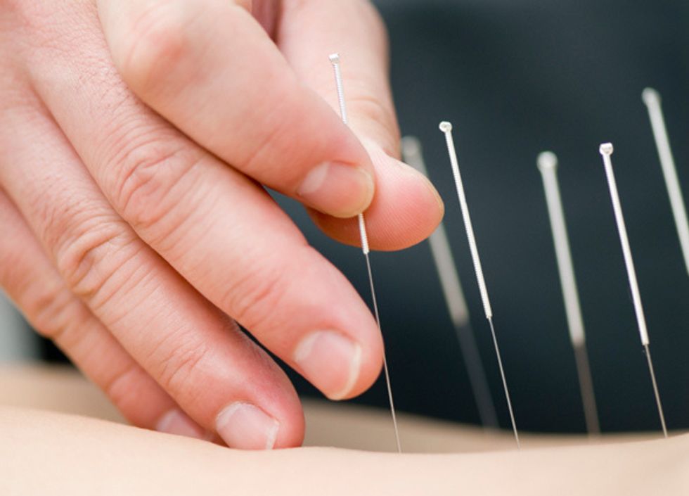 Things Need To Know Before Acupuncture Therapy