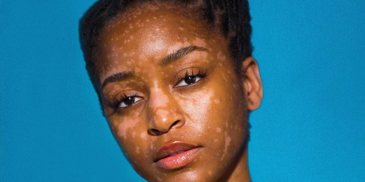 Women With Unique Skin Share How They Learned To Love Their Purpose-Built Beauty