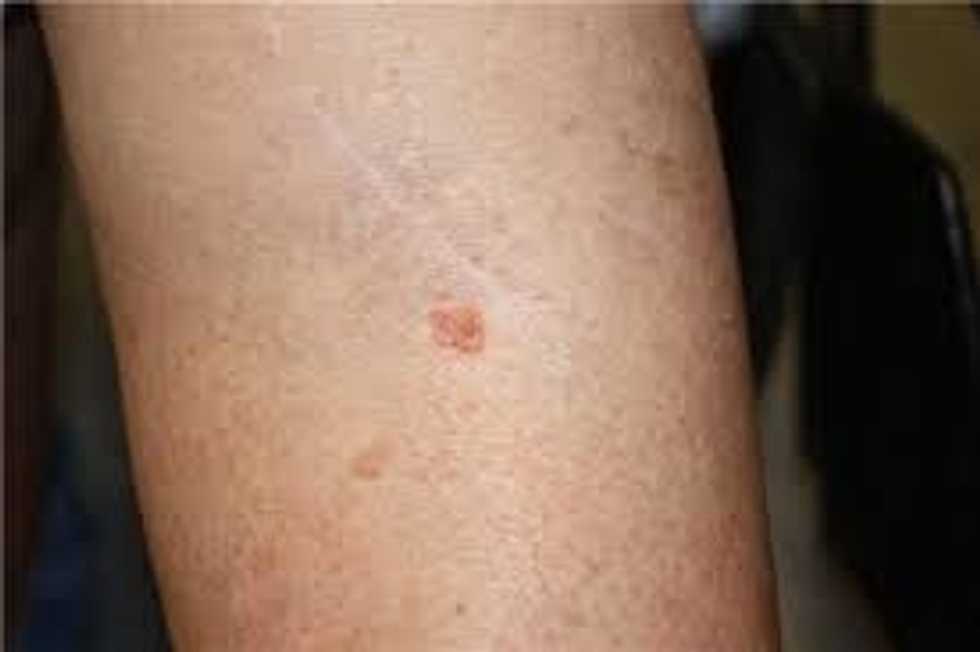 Skin Cancer: Not Just A Summer Thing