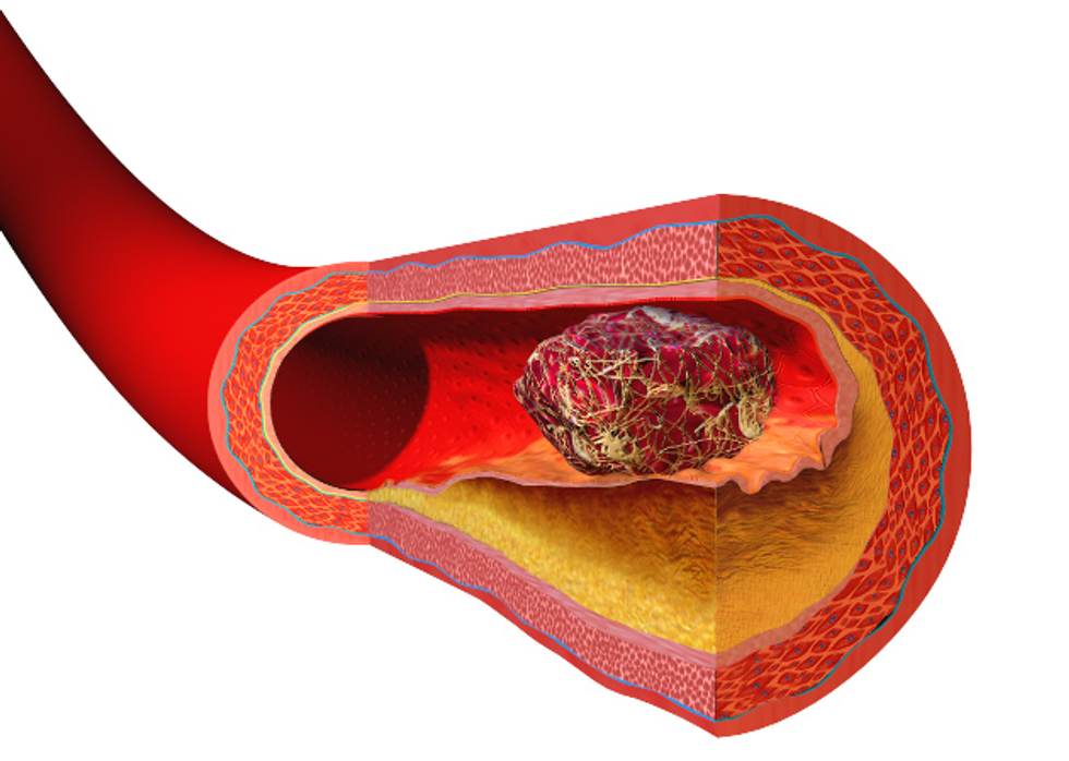 New Drug Approved For Deep Vein Thrombosis