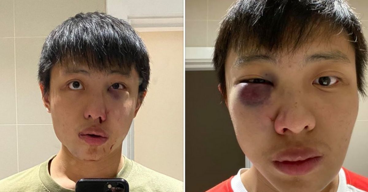 Asian Student Says A Group Of Men Assaulted Him And Told Him 'I Don’t Want Your Coronavirus In My Country'