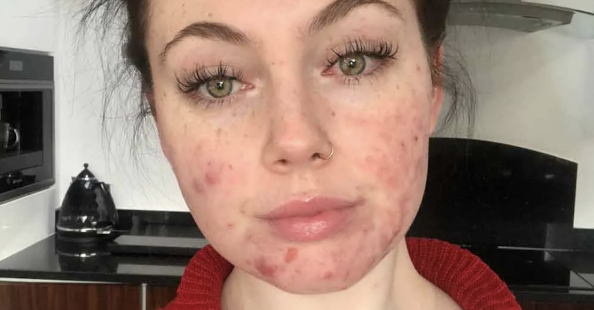 Young Teacher Who Nearly Quit Her Job After Battling Severe Acne Helps Others With The Power Of Social Media
