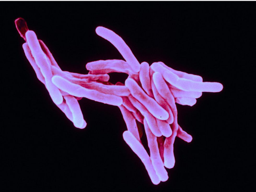 This Week In Health: A Tough Strain Of Tuberculosis