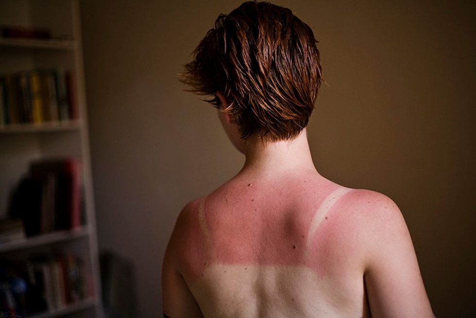 Sunburn Treatment: Can’t Rush Healing, But Use These Tips For Comfort