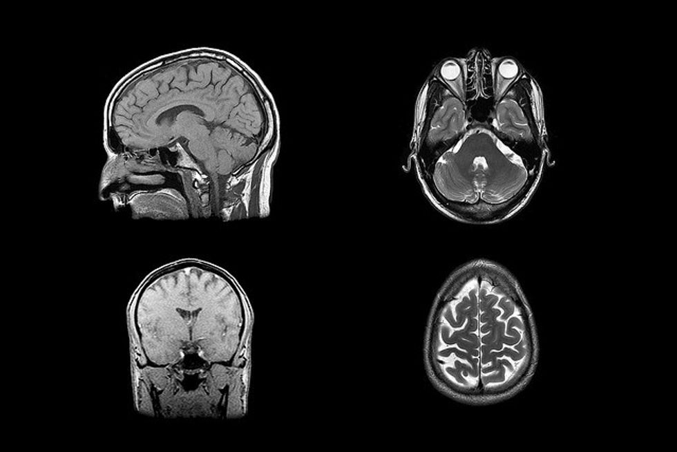 This Week in Health: New Hope For Alzheimer’s Treatment