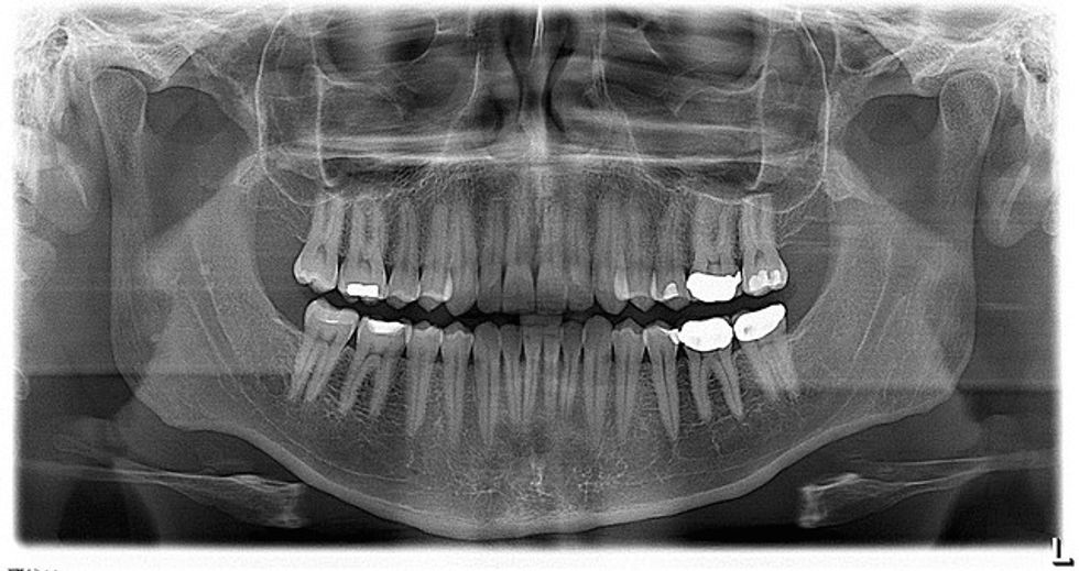 Add Bite To Your Retirement Dental Plan