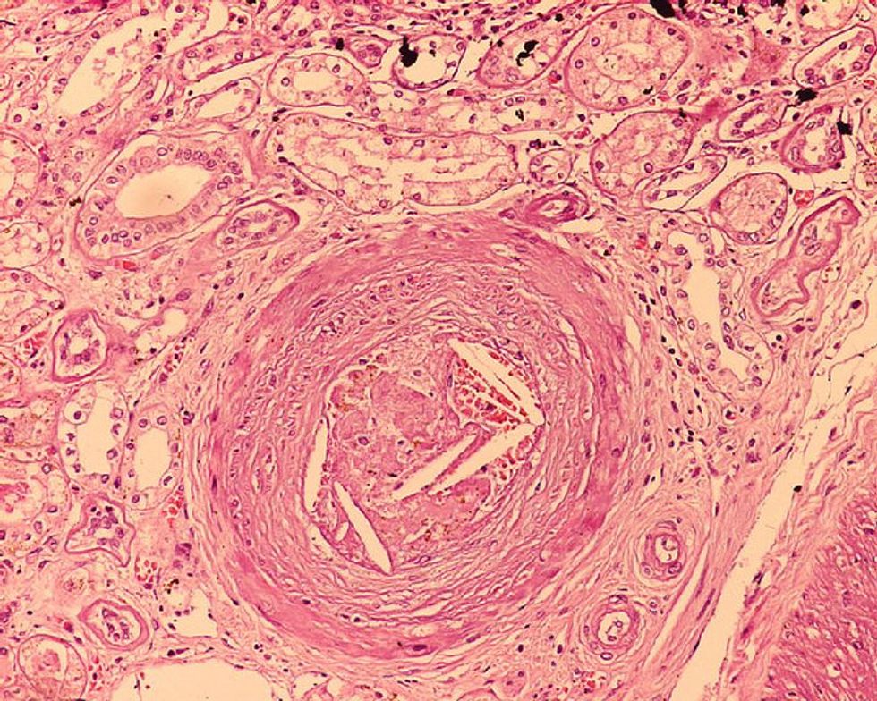 Independent Group Finds New Cholesterol Drugs Far Too Costly