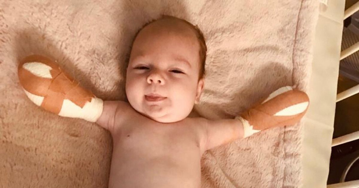 Baby Who Had A Stroke While In The Womb And Six Operations To Remove Her Limbs Still Has 'Biggest, Brightest Smile' Through It All