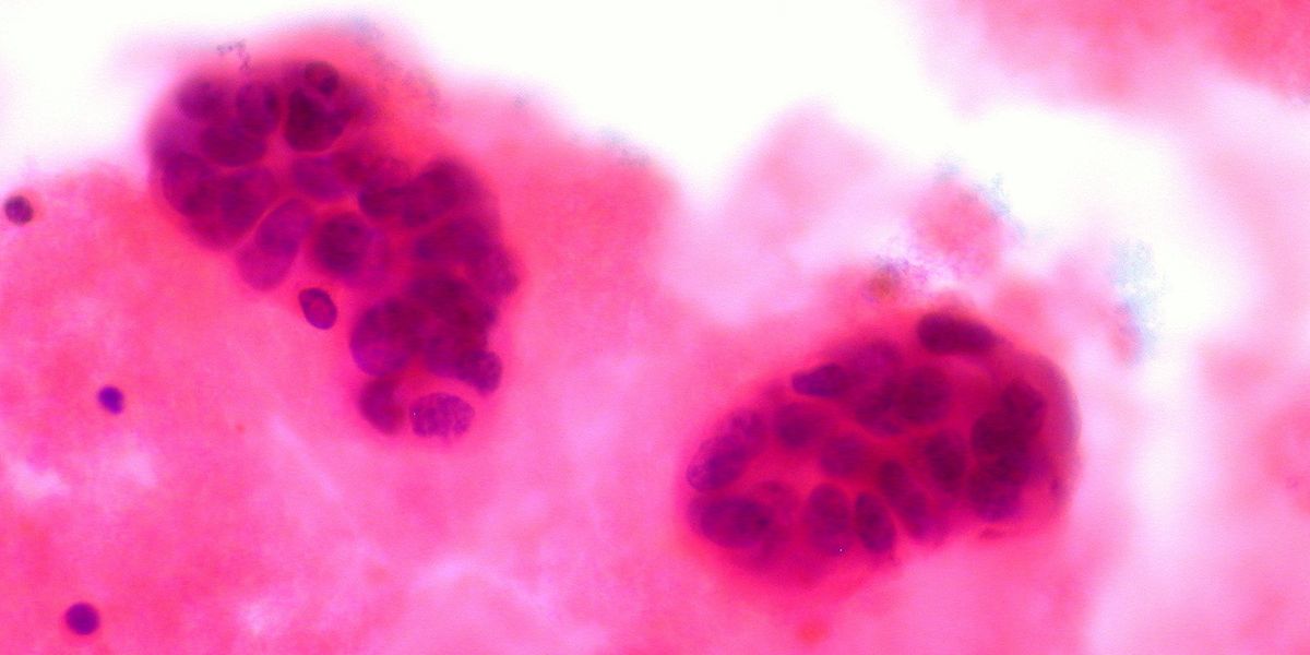 BPA triggers changes in rats that may lead to breast cancer