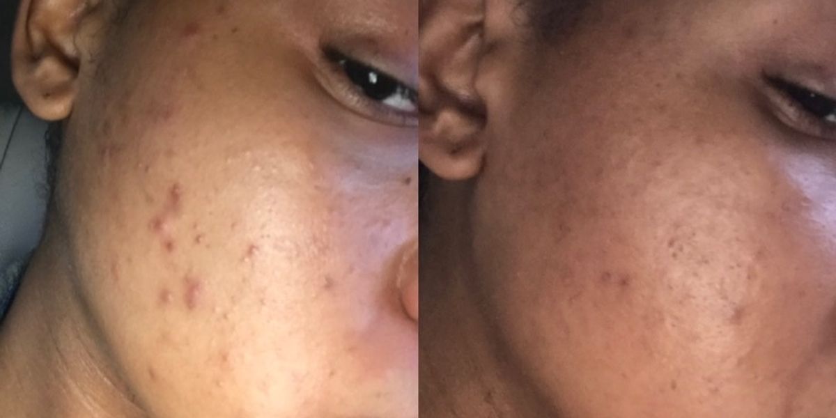 The Skincare Routine That Got My Cystic Acne All The Way Together