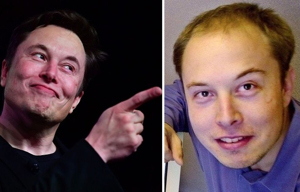 Elon Musk Hair Transplant