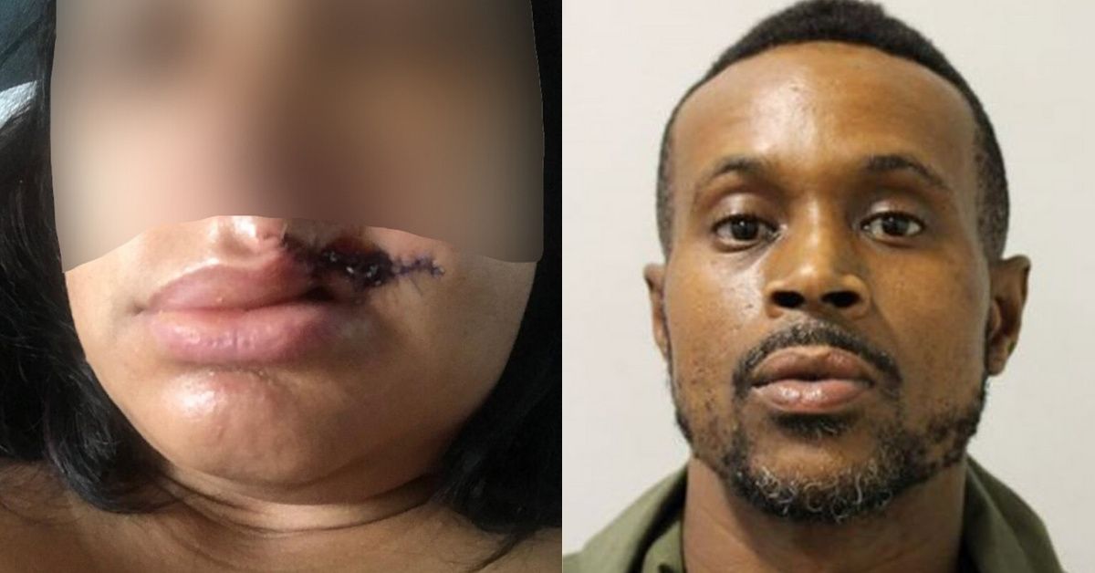 Mom Who Had Part Of Her Lip Bitten Off By A Stranger At A Carnival Is Now Too Scared To Go Out Alone
