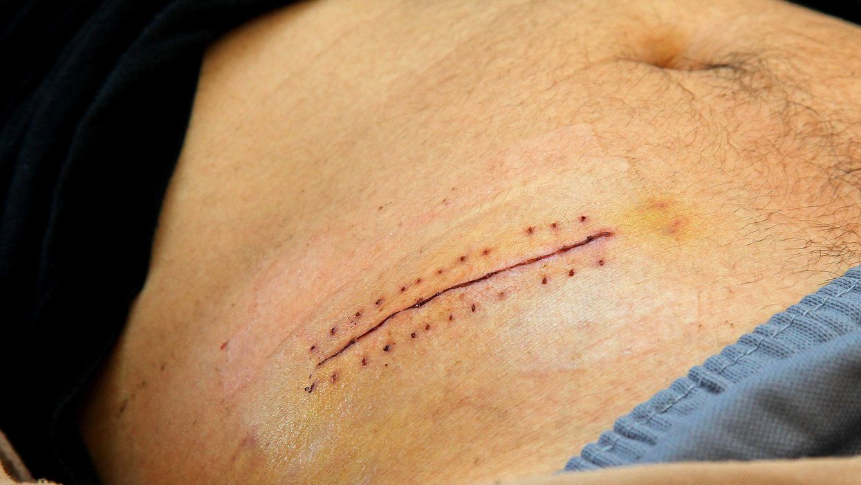 People Recount The Dumbest Ways They've Ever Gotten A Scar