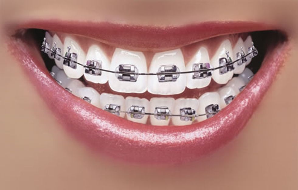 How to braces B+C Guides