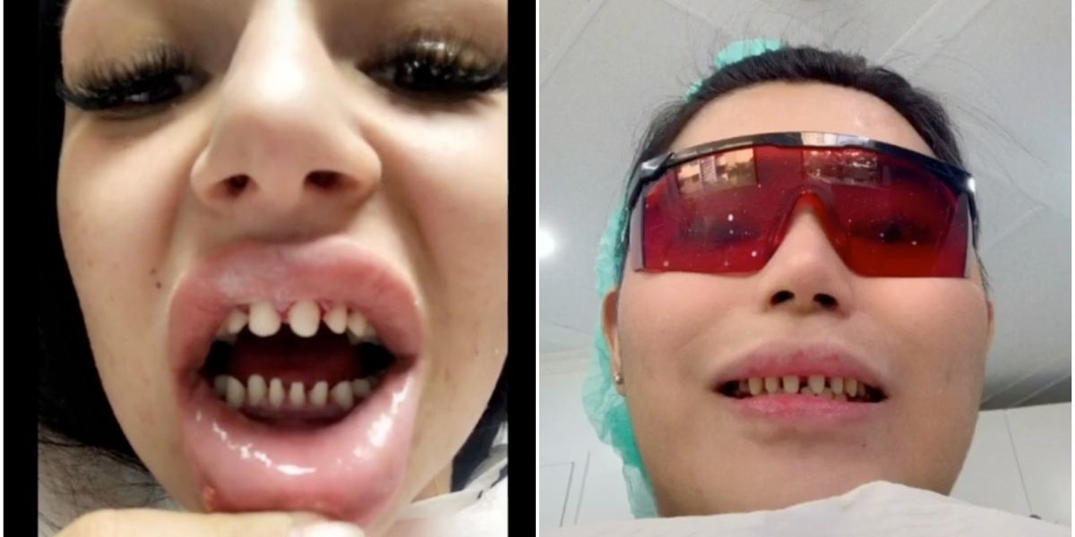 TikTok Dentists Are Warning Against the Viral 'Veneers Check' Trend