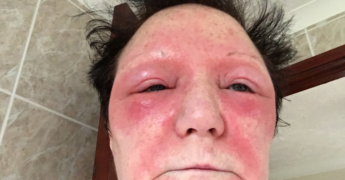 Teacher Praises Miracle Cream For 'Saving' Her From Skin Condition That Made Even Blinking Painful