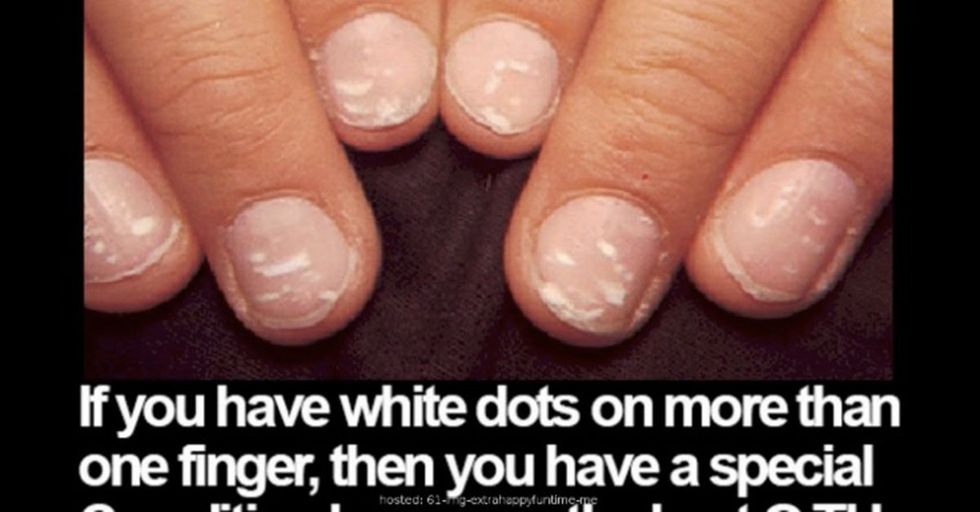 Those White Dots On Your Fingernails Can Indicate A Lot More Than You Realize About Your Health 22 Words Those White Dots On Your Fingernails Can Indicate A Lot More Than You Realize About Your Health 22 Words