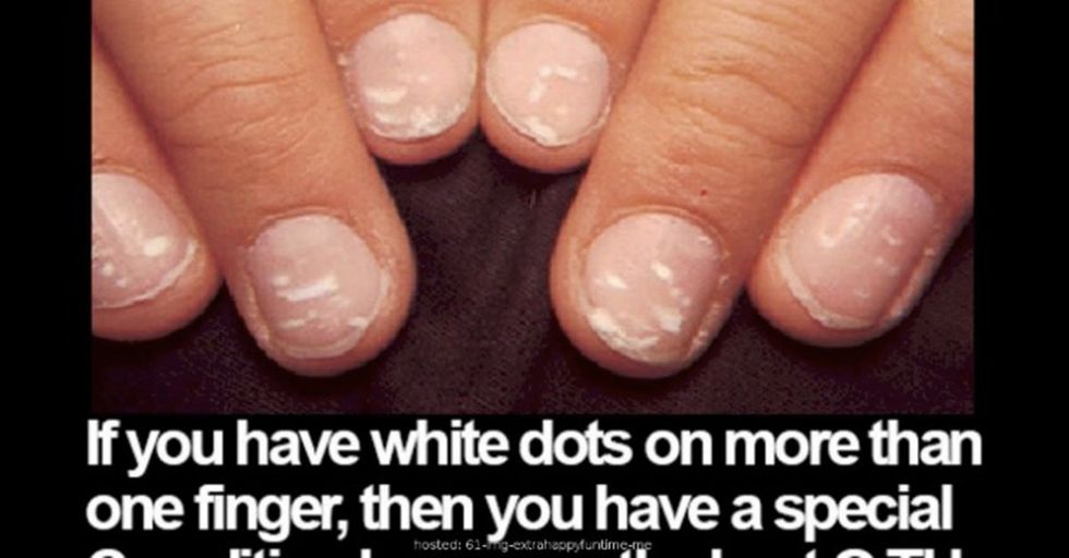 Those White Dots On Your Fingernails Can Indicate A Lot More Than You Realize About Your Health 22 Words