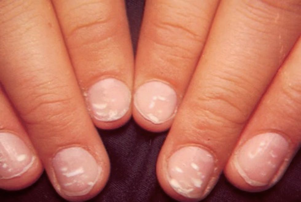 here-s-what-the-white-spots-on-your-nails-mean-reader-s-digest