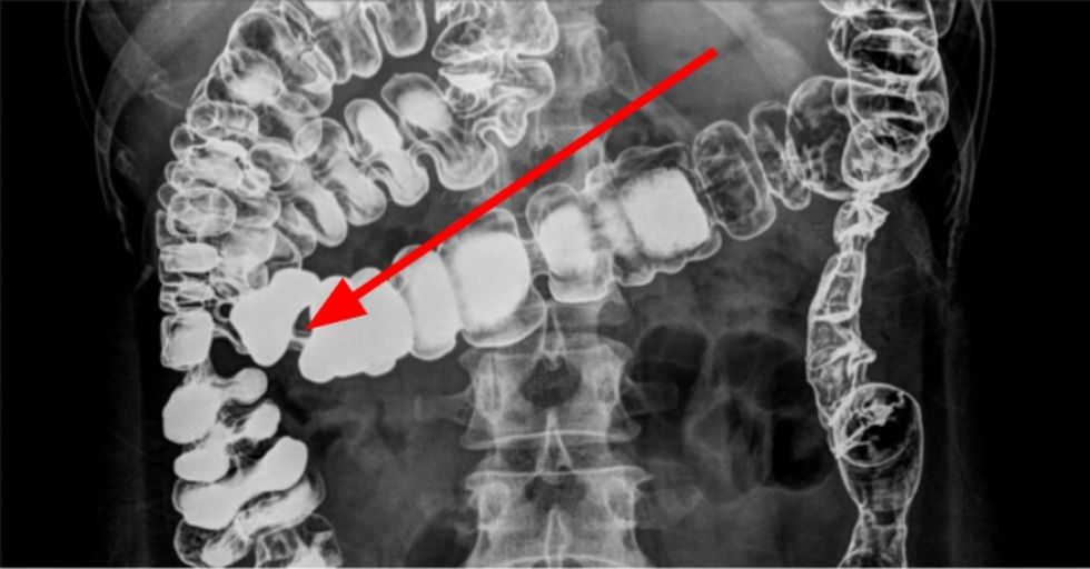 Jefferds recommends best of Hole in the intestine in adults in intestine Hole adults the in