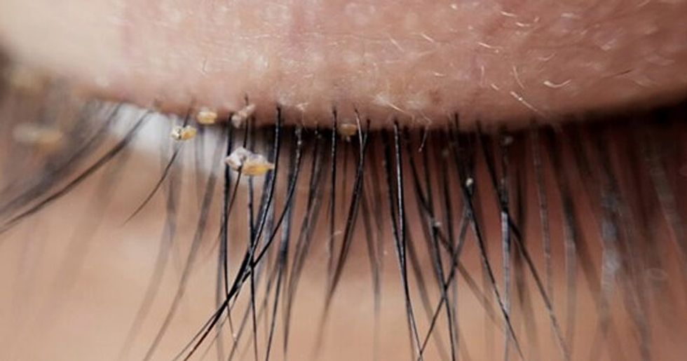 lash-lice-are-becoming-more-common-in-eyelash-extensions-doctors-warn