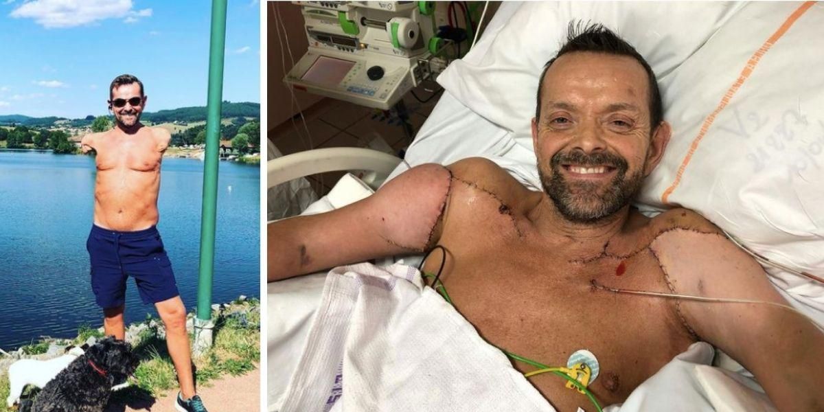 Man with double arm transplant seeing rapid nerve progress - Upworthy