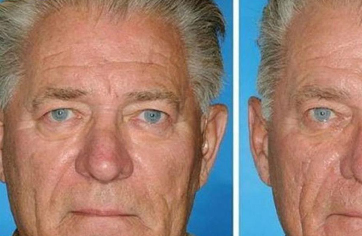 smokers versus non-smokers, smokers' skin, twins