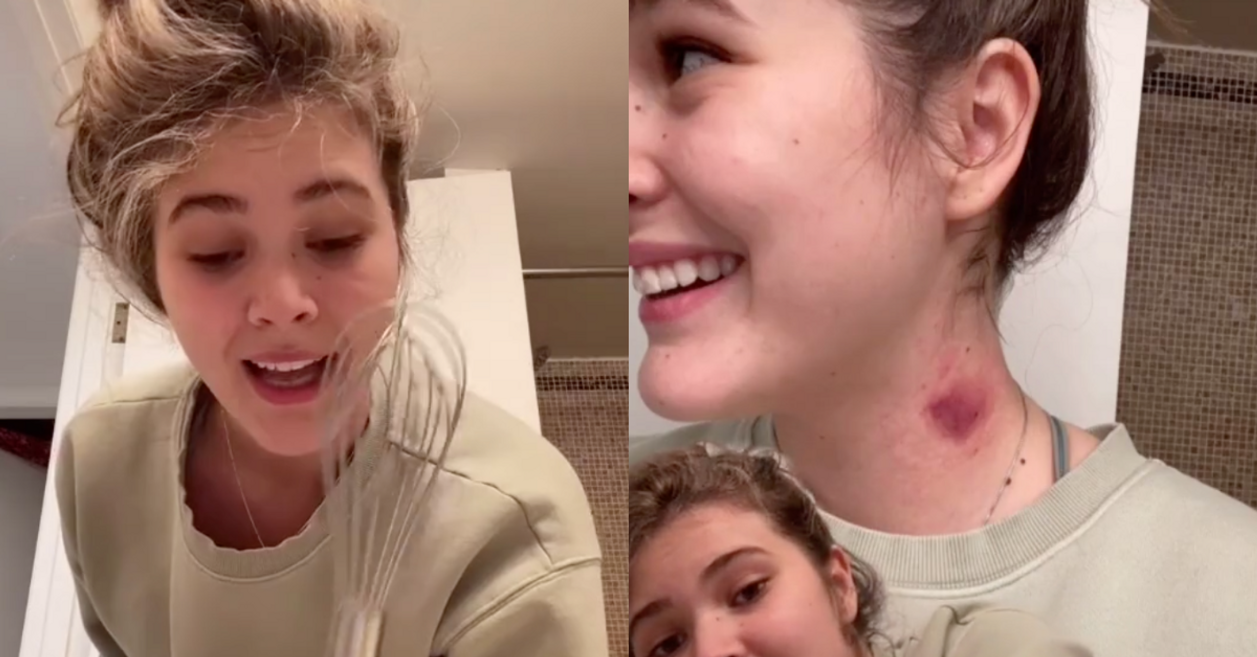 Teen Goes Viral After Discovering Unusual Whisk Hack For Getting Rid Of Hickeys—And It Actually Works