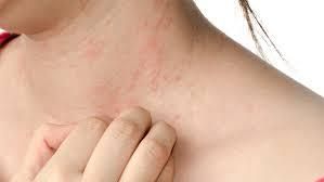 Allergy Types, Causes, Symptoms & Treatment: Dr. Naval Parikh